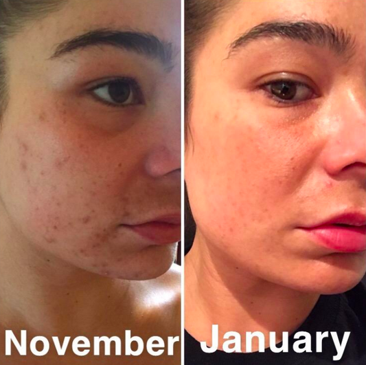 How Ecoistka USA Shea butter blend Can Impact Acne Scars